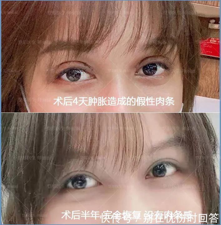 肉条感|双眼皮术后出现肉条的不同原因和修复方法
