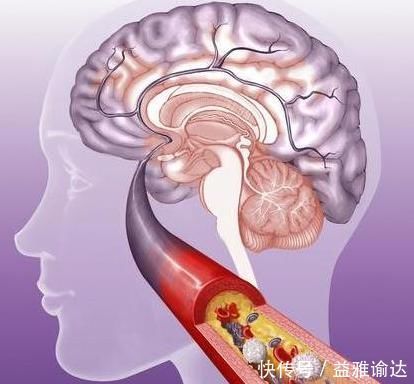 远离脑梗,晨起二不要,睡前二不要,多吃三物,血管通畅病不找