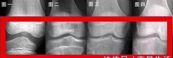 长高|孩子停止长高的几个迹象,若其中一个提前出现,当心伴随着性早熟