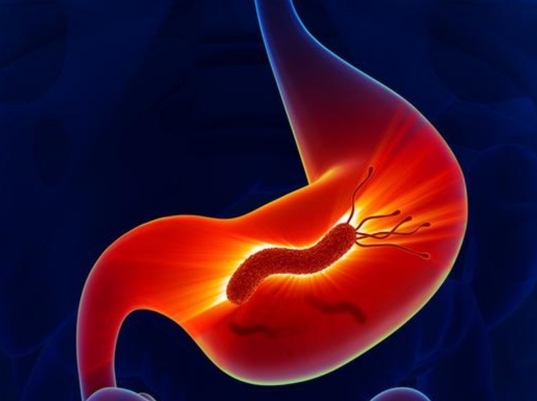 致癌物质|全球胃癌患者50中国人,营养专家呼吁3种食物要少碰