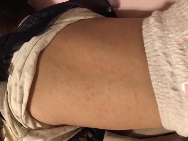 降温|6个月后宝宝第一次发烧,多是幼儿急疹,烧退疹出,免疫力升级2.0