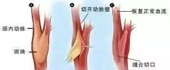 血液|德国颠覆性研究：动脉硬化斑块并非来自血液中的脂肪