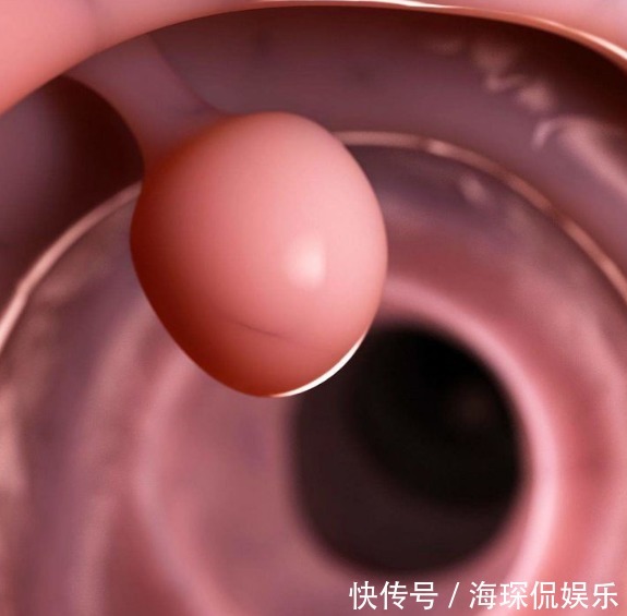 3种肠息肉一定要及时切除,没事常吃3种食物,可更好预防肠癌