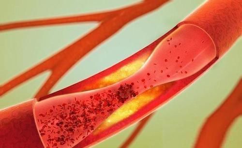 血液|此物是天然的“血栓杀手”,常吃点,血管通畅,身体更健康