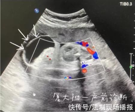 肿瘤|崩溃!厦门一女子怀孕5个月，发现胎儿竟有“尾巴”，医生说……
