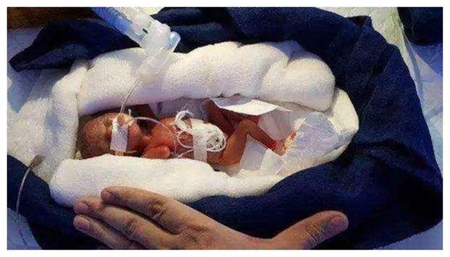 睡眠时间|14年前的“巴掌女婴”,出生只有半斤重,现在怎么样了?