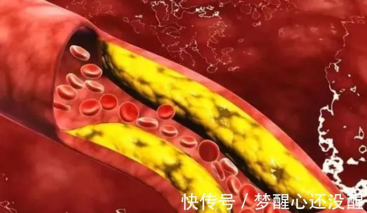 苹果|血脂高,夏天能吃葡萄吗?医生:“3种水果”或可常吃,血脂稳定