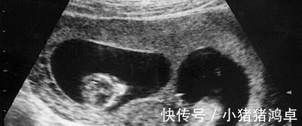 产房|38岁高龄产妇,生下女儿3天后又进入产房,网友世上还有这回事