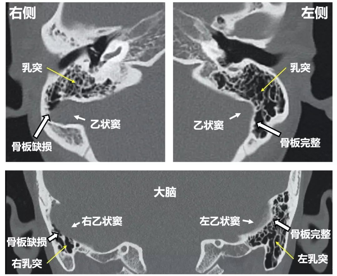 患者|“咚、咚、咚…”两年了，声音从未在耳边消失，她感觉自己得了一种怪病