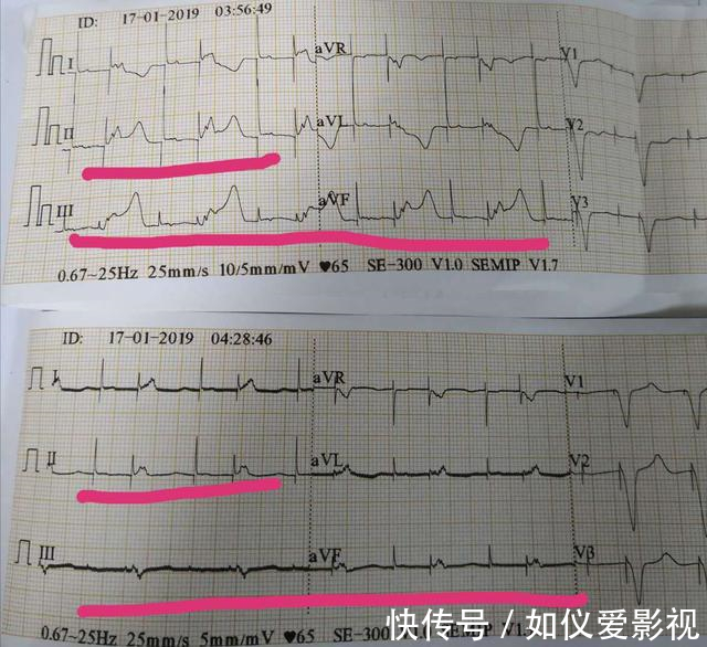 寿命|人的心跳快了长寿,还是慢一点长寿?医生说:跳这么快最长寿!