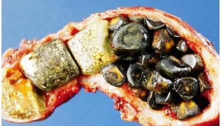 金钱草|胆结石一定要做手术？先看“5种”自然治疗方法