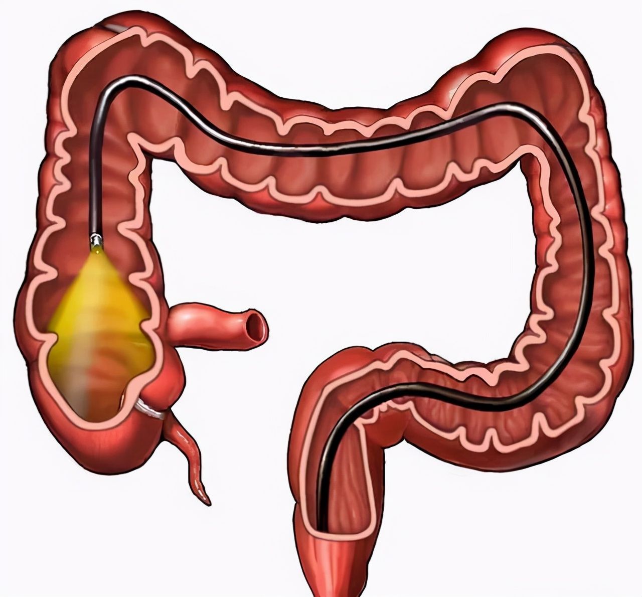 肠镜|做无痛胃肠镜，为什么先做胃后做肠？