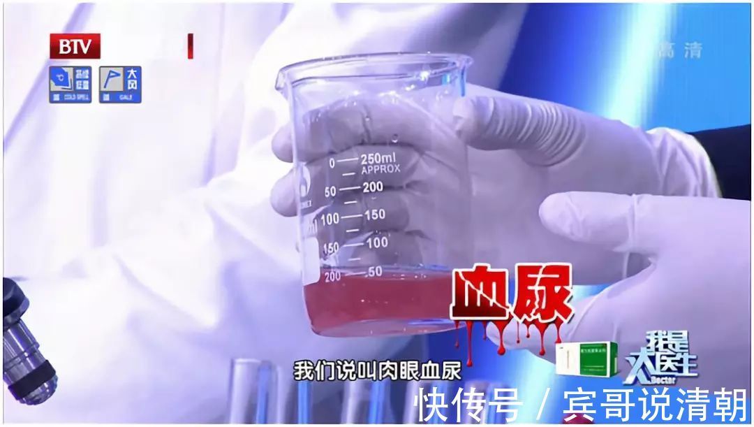 结石|致命肾癌竟是结石惹的祸2大饮食习惯暗藏风险，可惜很多人不知