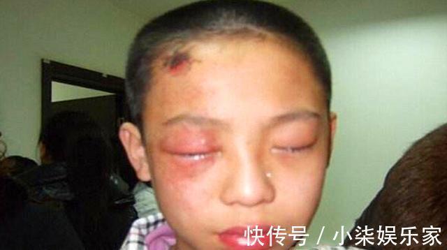 石灰|3岁男孩把石灰撒进眼睛,妈妈却不敢用水洗,事后医生骂无知