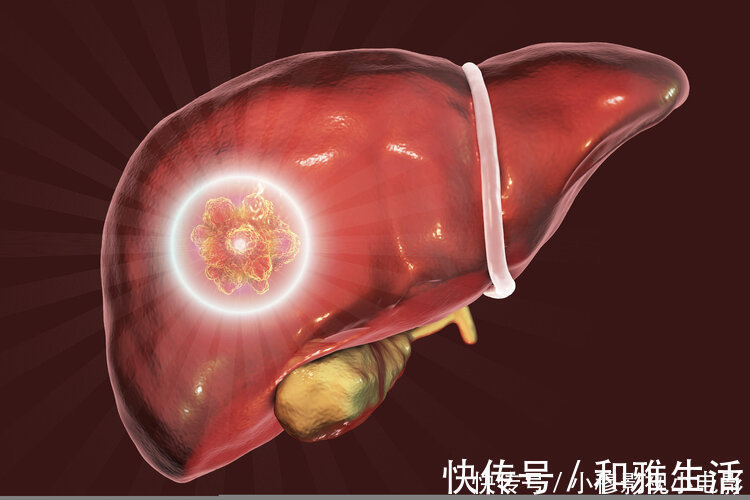 预防肝硬化|重视:除了皮肤小红点,身体出现4个异常,可能是肝硬化“敲门”