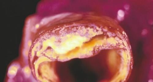 心脑血管疾病|甘油三酯飚高?1种水坚持喝15天,狂降甘油三酯,连血脂也跟着