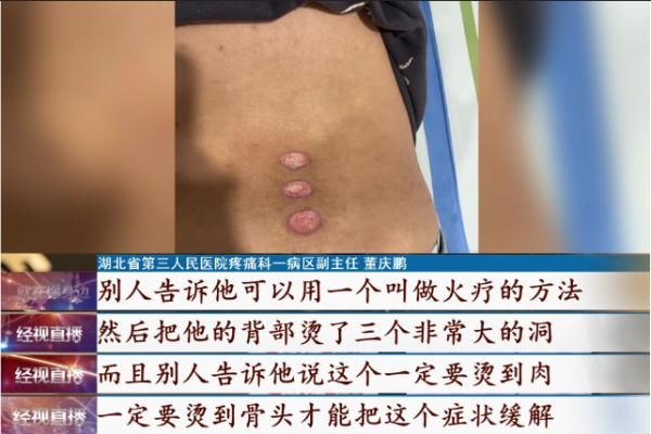 腰椎间盘突出|“土方法”治腰痛？肉都烫烂了......