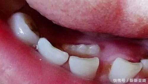 孩子“乳牙”脱落别着急扔,关键时刻能救命不懂为啥尽快了解下