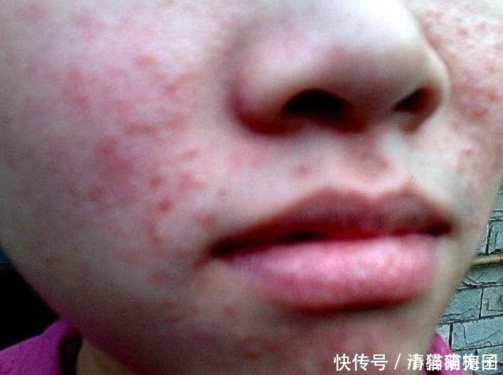 脸上痘痘反复长很困恼别怕！教你5个方法，帮你快速清除痘痘！