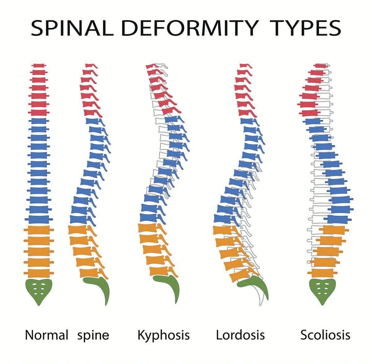 脊柱侧弯|经常头晕、耳鸣、失眠?1个部位被压迫了,对照4个症状看看