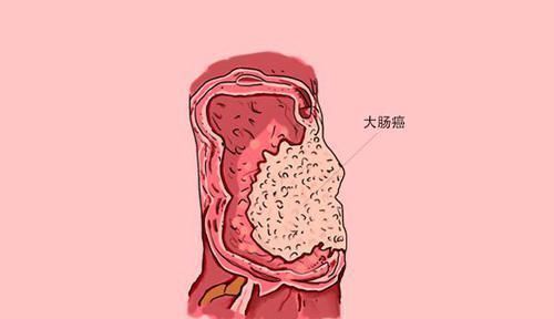 乳腺癌|哪些癌症及时发现及时治疗,治愈率高早点了解,别轻易放弃
