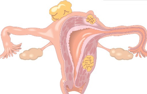 性激素|妇科医生提醒女人有这5个症状,暗示你可能患卵巢癌,别忽视