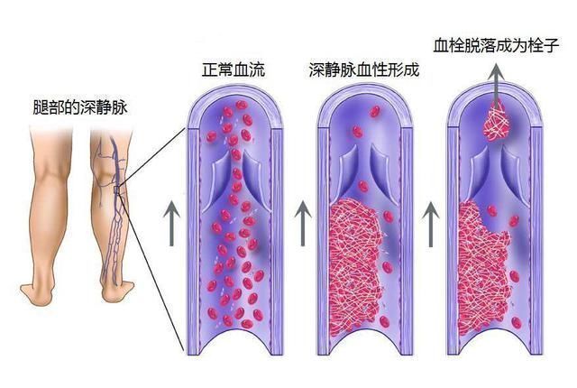手机|60岁的静脉血栓发生于9岁孩子,久坐危害就这些孩子,爸妈错了