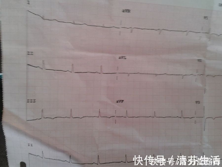 心脏病|体检报告写“窦性心律不齐”,指的是什么?一次性给大家讲清楚