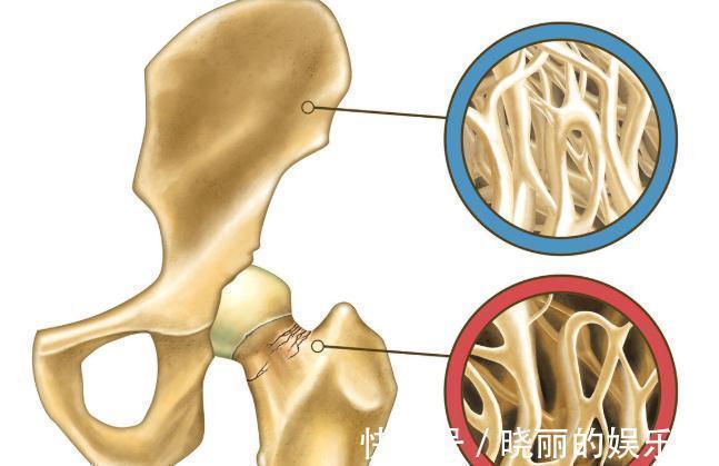 骨密度|长期吃这5种药,有骨质疏松的副作用!如果你在吃,建议尽早更换
