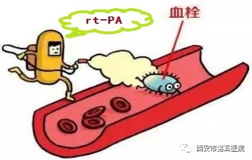 缺血性脑卒中|【静脉溶栓】静脉溶栓知多少？