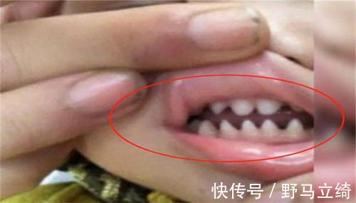 乳牙|儿子长了一口“鲨鱼牙”,妈妈连忙送医,医生无知害了孩子