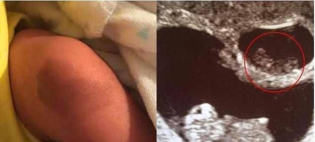 双胞胎姐姐“消失”在腹中,化为弟弟腿上的胎记