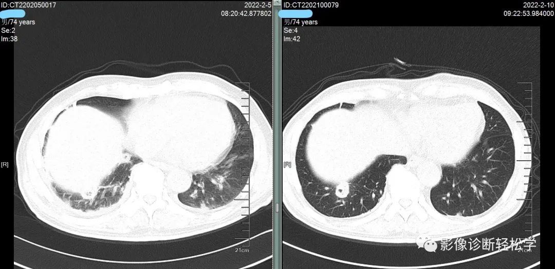 金葡菌|快快乐乐过大年，轻松学习肺部影像 实战篇 续