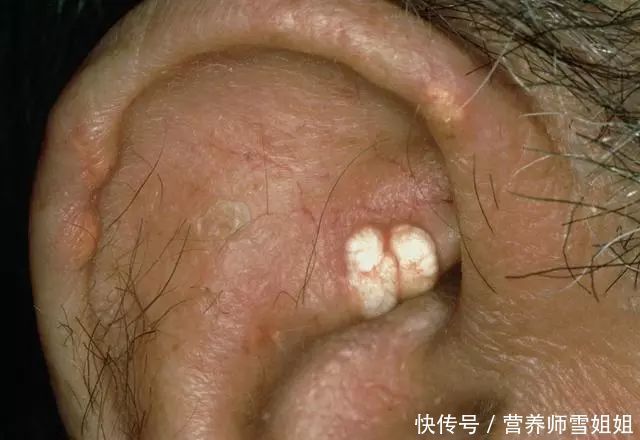 发病|冬季,痛风高发,这4类人,一旦出现3个症状,尿酸高的可怕了
