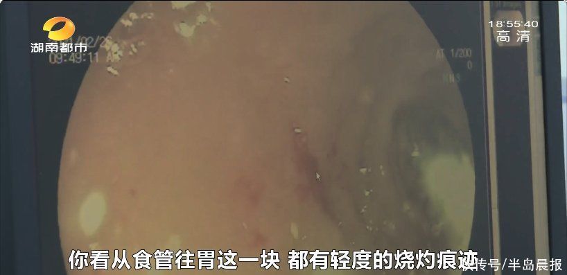 家里这些东西收好了！5岁男孩咬破废旧电池，被灼伤紧急送医