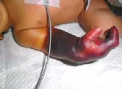 截肢|宝爸宝妈们,这些东西你家都有,它可能会导致宝宝面临截肢!