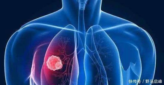 肺癌|肺癌一发现都是晚期错早期往往有蛛丝马迹,是身体在向你求救