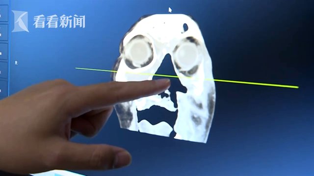 柴先奇|震惊！八旬大爷鼻子发痒 医生从里面取出36条蛆