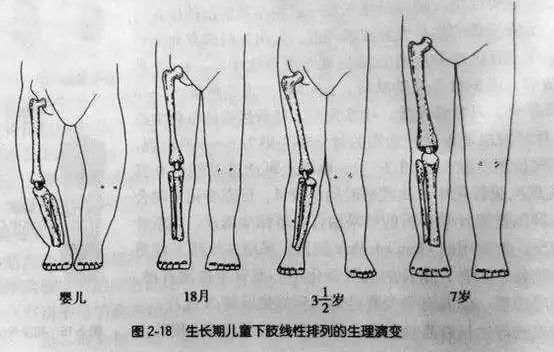 宝宝|【儿医说】孩子站立走路早会引起腿弯？NO！别耽误了孩子的运动发育