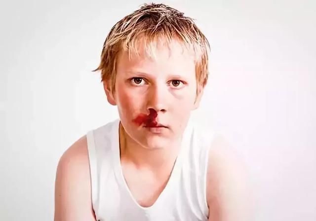 孩子经常流鼻血是因为患上白血病?正确的