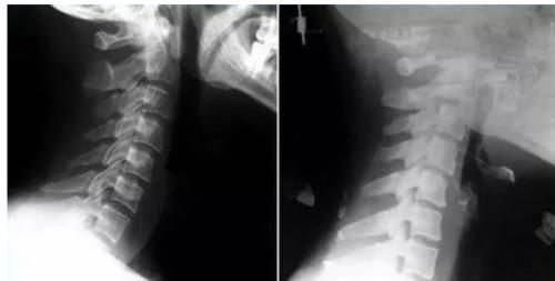 脖子|颈椎病竟能引发心绞痛！脖子造成的心脏病，你了解多少？