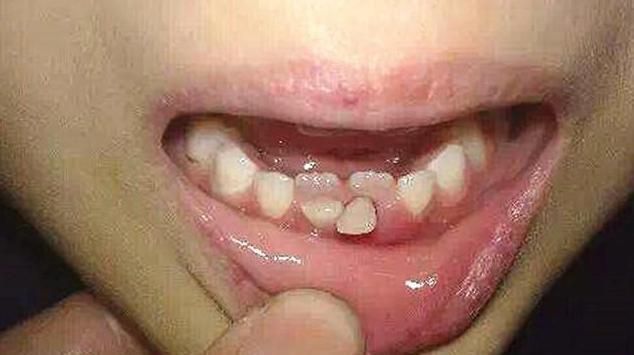 糖果|越来越多孩子长“双排牙”,与糖果无关,是父母喂养有误区