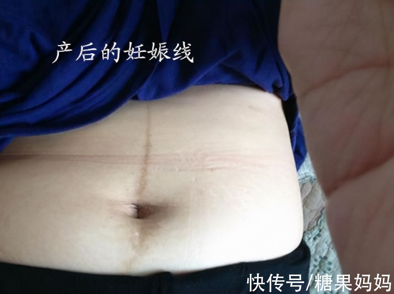 白线|准妈妈孕肚上的“神秘”黑线,能预知胎宝性别?那可不一定