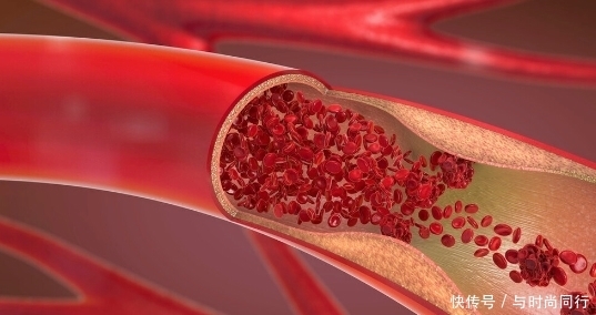 心脑血管疾病的“冠军药”,你都清楚吗?医生列详细,值得收藏