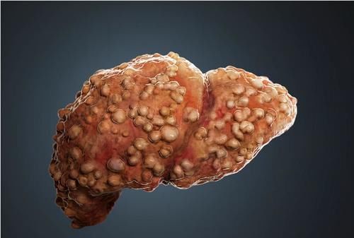 克星|肝硬化的“克星”来了,不是枸杞是它,快速养好肝、身体更健康