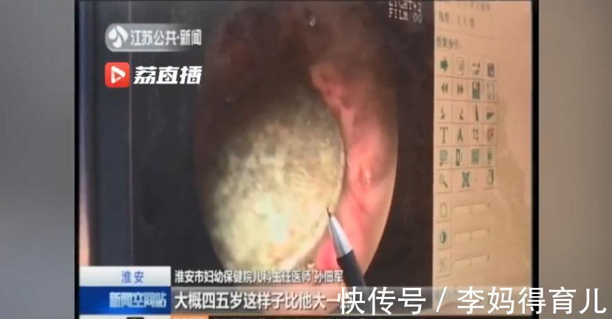 医生|18个月的宝宝误吞硬币,胃部已被腐蚀,宝爸宝妈注意!