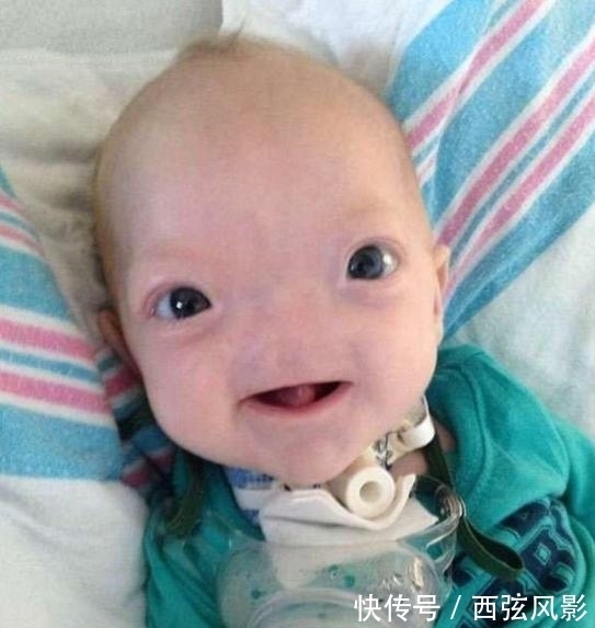 鼻子|小男孩刚出生就没有鼻子,但是他的笑容感染了多少人