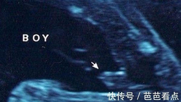 孕囊|记住了!四维单子上有这3个亮点和男女有关