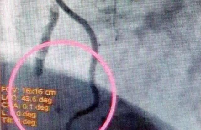 动脉斑块可怕吗?心血管医生告诉你真相!