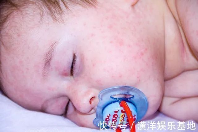 黄疸|宝宝湿疹反复太难缠，妈妈好心疼，对付宝宝湿疹弄懂这些很有必要